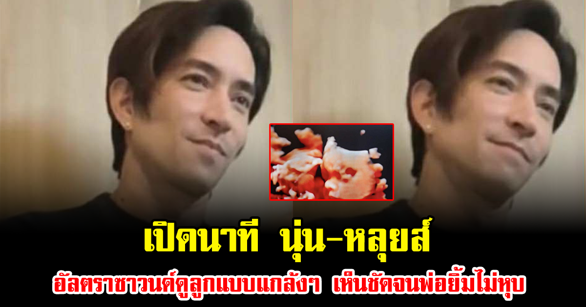 เปิดนาที นุ่น-หลุยส์ อัลตราซาวนด์ดูลูกแบบแกล้งๆ เห็นชัดจนพ่อยิ้มไม่หุบ