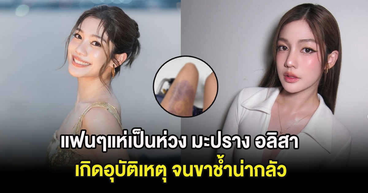 แฟนๆแห่เป็นห่วง มะปราง อลิสา เกิดอุบัติเหตุ จนขาช้ำน่ากลัว