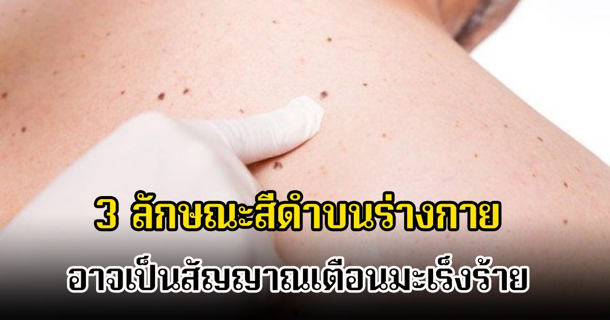 อย่าชะล่าใจ! 3 ลักษณะสีดำบนร่างกาย ไม่ใช่แค่ไฝหรือขี้แมลงวัน อาจเป็นสัญญาณเตือนมะเร็งร้าย