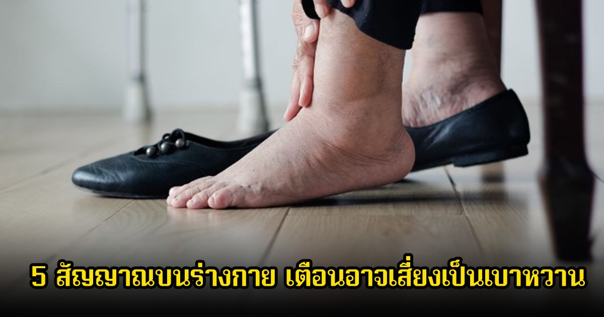 หลายคนมองข้าม! 5 สัญญาณบนร่างกาย เตือนอาจเสี่ยงเป็นเบาหวาน