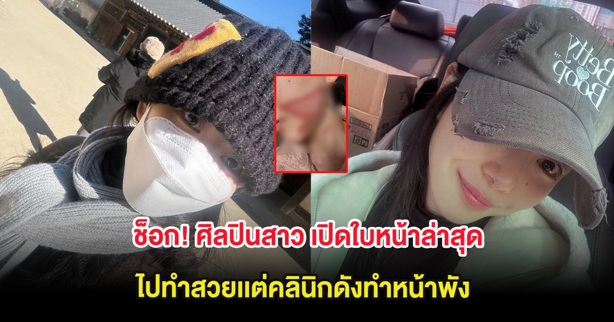 ช็อก! ศิลปินสาว เปิดใบหน้าล่าสุด ไปทำสวยคลินิกดังแต่หน้าพัง จนน่ากลัว (ต่างประเทศ)