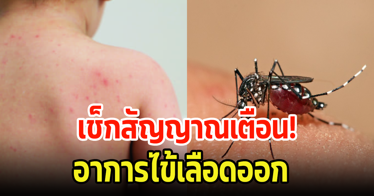 เช็กเลย! สัญญาณเตือน ไข้เลือดออก ใครมีอาการรีบหาหมอด่วน