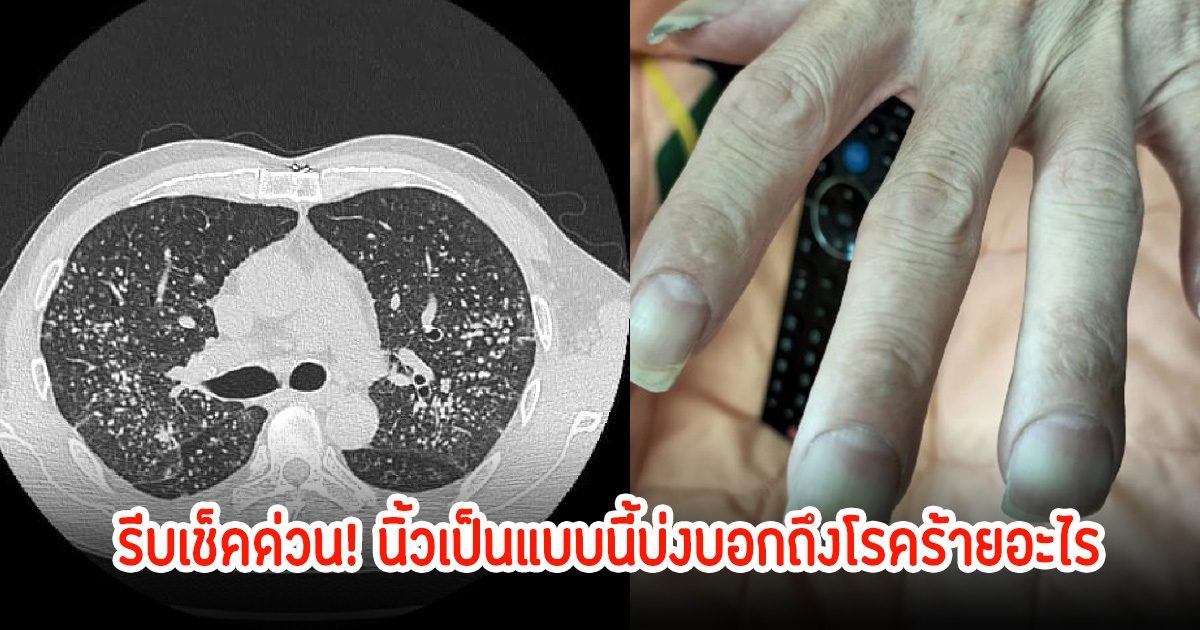 รีบเช็คด่วน! นิ้วเป็นแบบนี้บ่งบอกถึงโรคร้ายอะไร หมอเตือน ใครเป็นรีบไป รพ. แต่ไม่ใช่ทุกคนจะเป็นง่ายๆ