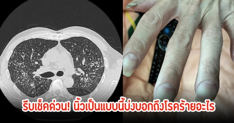 รีบเช็คด่วน! นิ้วเป็นแบบนี้บ่งบอกถึงโรคร้ายอะไร หมอเตือน ใครเป็นรีบไป รพ. แต่ไม่ใช่ทุกคนจะเป็นง่ายๆ