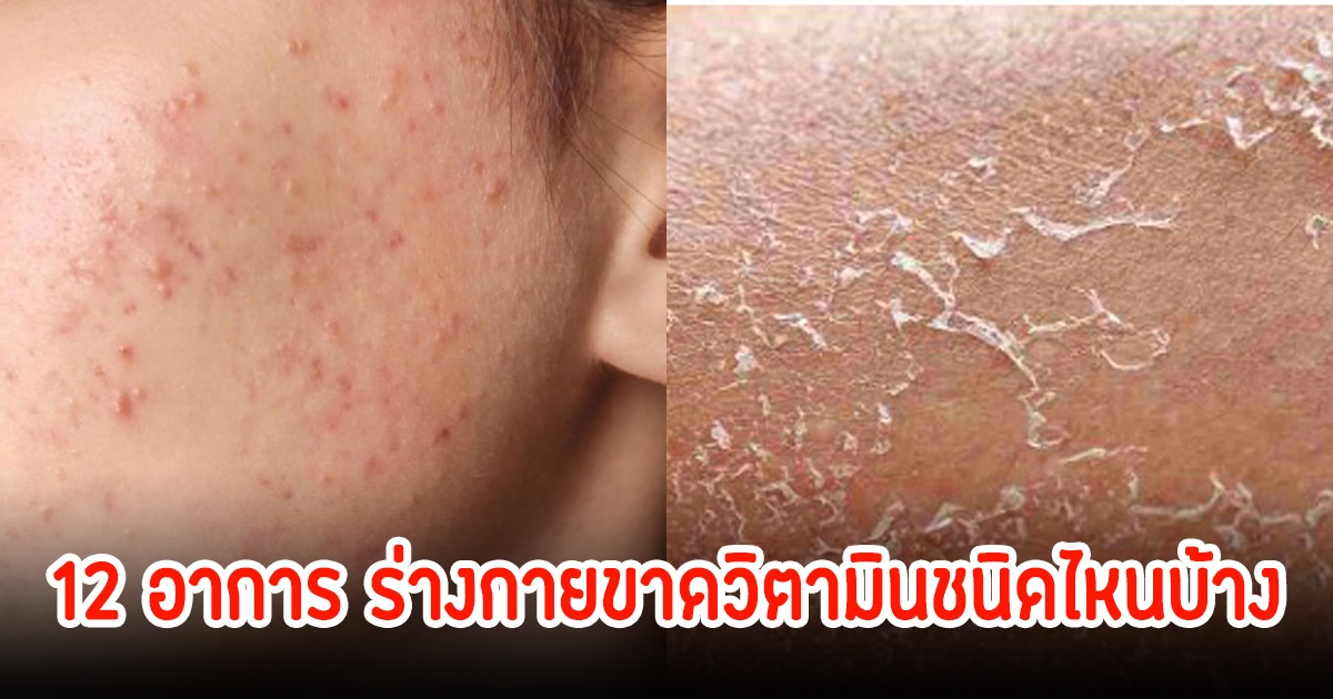 สัญญาณเตือน! 12 อาการผิดปกติ ในร่างกายขาดวิตามินชนิดไหนบ้าง