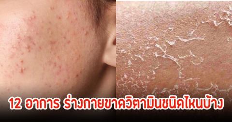 สัญญาณเตือน! 12 อาการผิดปกติ ในร่างกายขาดวิตามินชนิดไหนบ้าง