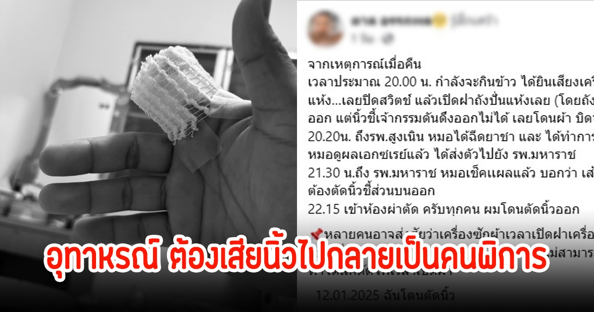 หนุ่มเผยอุทาหรณ์ ต้องเสียนิ้วไปเพราะเครื่องปั่นผ้า กลายเป็นคนพิการ เสียใจอาจจะไม่ได้กลับไปเล่นดนตรีอีก