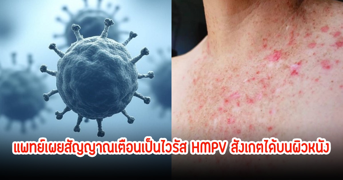 แพทย์เผยสัญญาณเตือนเป็นไวรัส HMPV สังเกตได้บนผิวหนัง