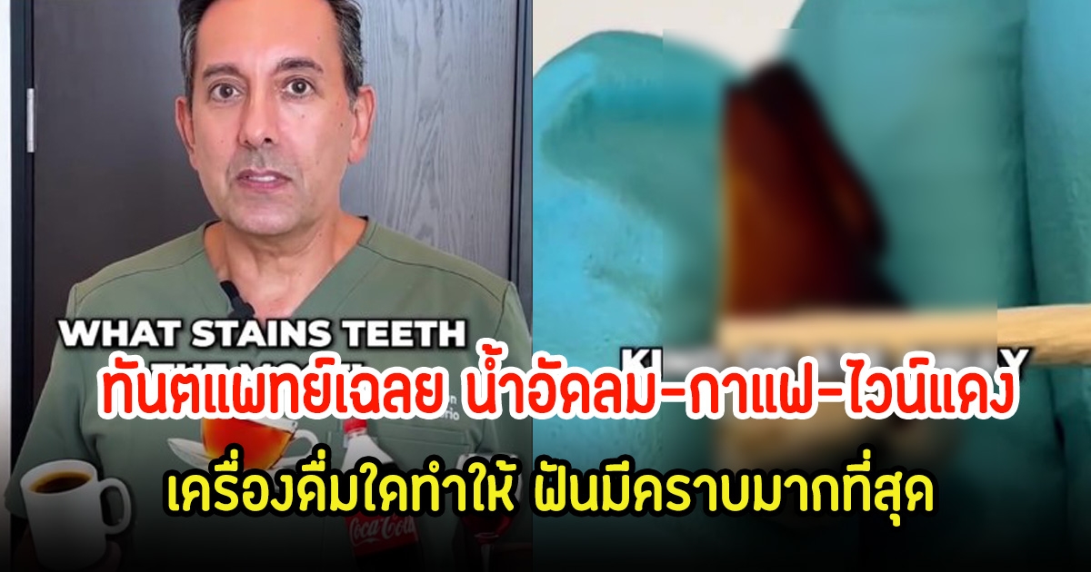 ทันตแพทย์เฉลย น้ำอัดลม-กาแฟ-ไวน์แดง เครื่องดื่มใดทำให้ ฟันมีคราบมากที่สุด