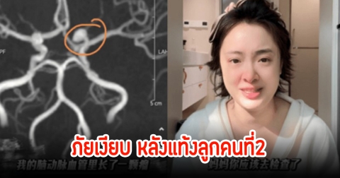 ภัยเงียบที่ซ่อนอยู่ ดาราสาวแท้งลูกคนที่2 ทำให้ตรวจเจอโรคในสมองที่คาดไม่ถึง (ข่าวต่างประเทศ)