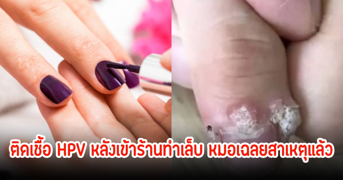 สาววัย 22 ปี กลายเป็นหูด หลังเข้าร้านทำเล็บ หมอเฉลยสาเหตุแล้ว