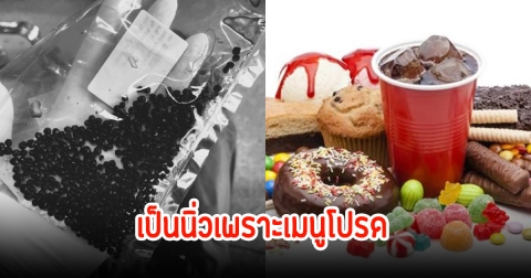 ช็อก! พบนิ่วในถุงน้ำดี 380 เม็ด สาเหตุเพราะเมนูสุดโปรด คนไทยกินบ่อยมาก เผยกลุ่มเสี่ยง