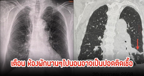 หมอเผย หญิงรายหนึ่งป่วยปอดติดเชื้อ หลังนอนห้องพักปิดมานานหลายเดือน คาดเกิดจากเชื้อโรคในแอร์
