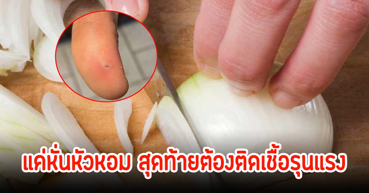 นึกไม่ถึง! สาวเตือน หั่นหัวหอมเจอเศษฝังลึกในนิ้ว สุดท้ายต้องติดเชื้อรุนแรง