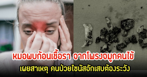 ช็อก! หมอพบก้อนเชื้อรา จากโพรงจมูกคนไข้ เผยสาเหตุ คนป่วยไซนัสอักเสบต้องระวัง