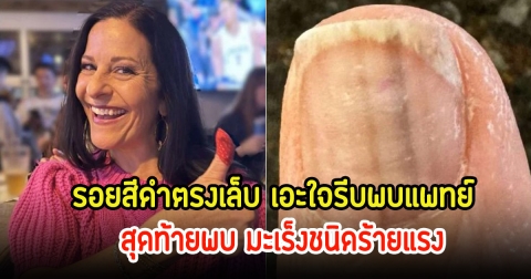 หญิงวัย 58 ปี เป็นรอยสีดำตรงเล็บ เอะใจรีบพบแพทย์ สุดท้ายพบ มะเร็งชนิดร้ายแรง เตือนสาวๆที่ชอบทำเล็บเจล