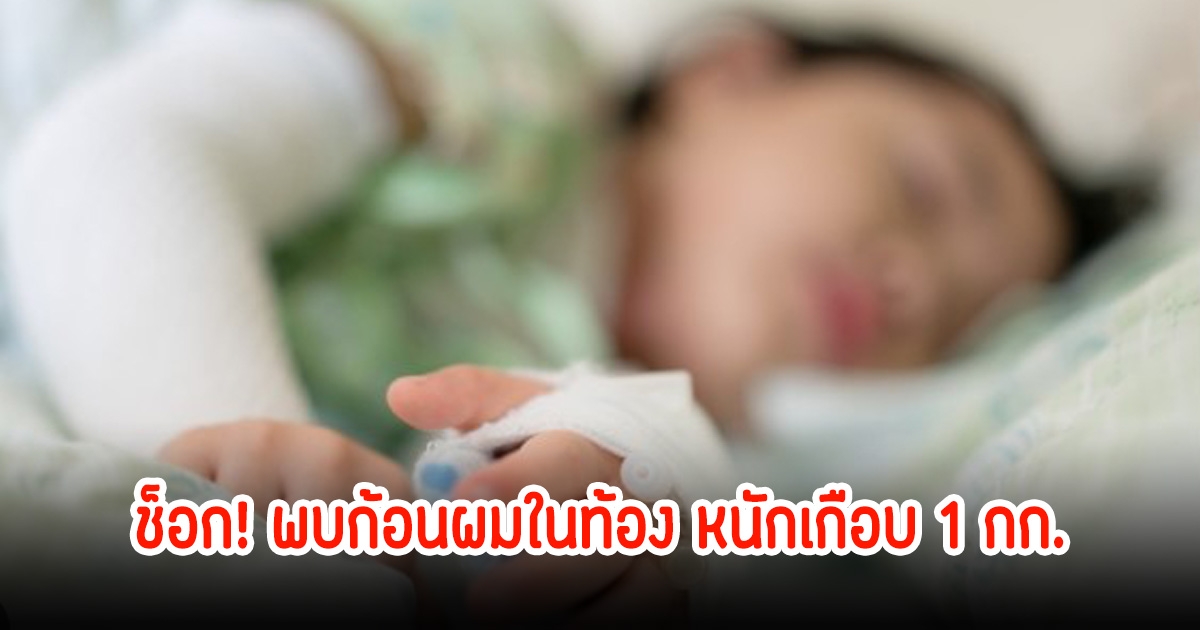 ช็อก! เด็กหญิงวัย 12 ขวบ พบก้อนผมในท้อง หมอเตือนอุทาหรณ์กับผู้ปกครองอย่าละเลย