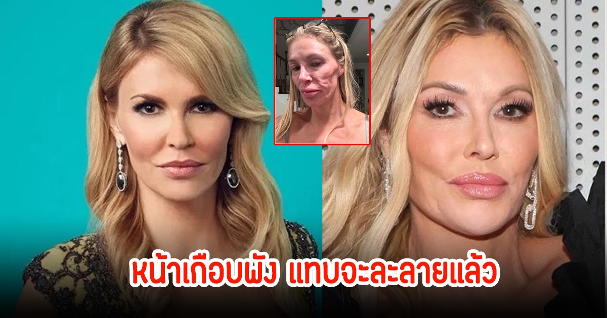 แบรนดี แกลนวิลล์ เปิดใจถึงอาการป่วยทางผิวหนังปริศนา ทำลายชีวิตและใบหน้าไม่กล้าทำงานในวงการอีก