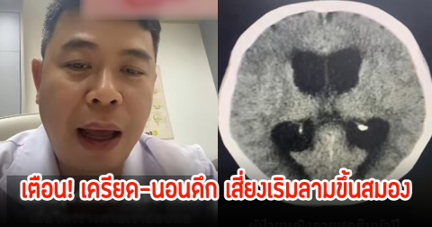 หมอเตือน! เครียด-นอนดึก ทำให้ร่างกายภูมิตก เสี่ยงเป็นเริมลามขึ้นสมอง