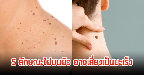 หมอเตือน! 5 ลักษณะไฝบนผิว อาจเสี่ยงเป็นมะเร็ง หลายคนมองข้าม