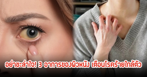 อย่าชะล่าใจ! 3 อาการของผิวหนัง-ร่างกาย บ่งบอกอาจไม่ใช่รอยช้ำธรรมดาๆ เตือนโรคร้ายใกล้ตัว