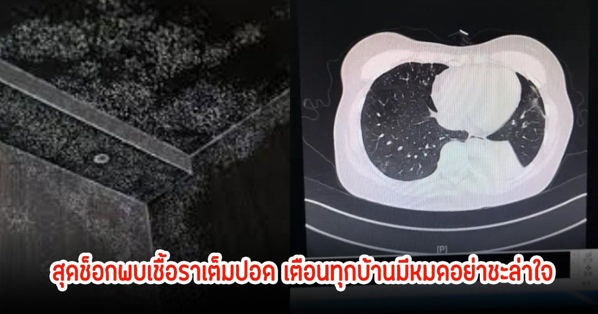 สาวเผยเก็บห้องเสร็จ จู่ๆไข้ขึ้นสูง สุดช็อกพบเชื้อราเต็มปอด เตือนทุกบ้านมีหมดอย่าชะล่าใจ