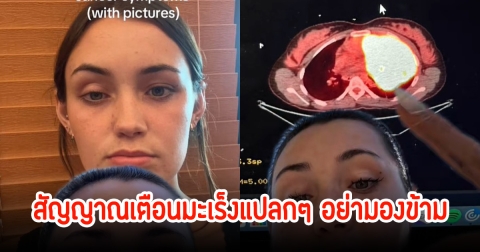 สาววัย 20 ปี เผยสัญญาณเตือนมะเร็งแปลกๆ หาหมอถึง5คนกว่าจะพบ หากไม่รีบรักษาอาจเสียชีวิตภายในไม่กี่เดือน