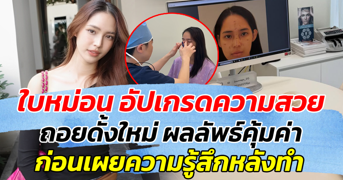 ใบหม่อน อัปเกรดความสวย ถอยดั้งใหม่ ผลลัพธ์คุ้มค่า ก่อนเผยความรู้สึกหลังทำ