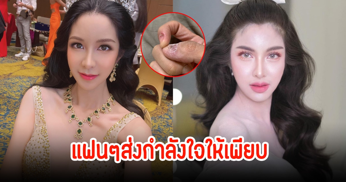 แฟนๆส่งกำลังใจให้ ฟิล์ม ทิฟฟานี่ เครียดหนัก ไม่สามารถห้ามตัวเองได้ กัดเล็บจนพัง