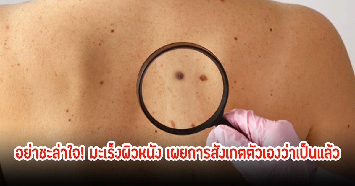 อย่าชะล่าใจ! มะเร็งผิวหนัง เผยการสังเกตตัวเองว่าเป็นแล้ว