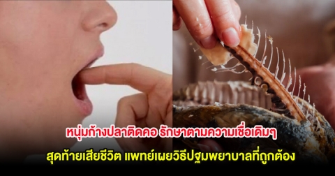 หนุ่มก้างปลาติดคอ รักษาตามความเชื่อเดิมๆ สุดท้ายเสียชีวิต แพทย์เผยวิธีปฐมพยาบาลที่ถูกต้อง (ตปท.)