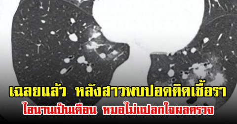 เฉลยแล้ว หลังสาวพบปอดติดเชื้อรา ไอนานเป็นเดือน หมอไม่แปลกใจผลตรวจ