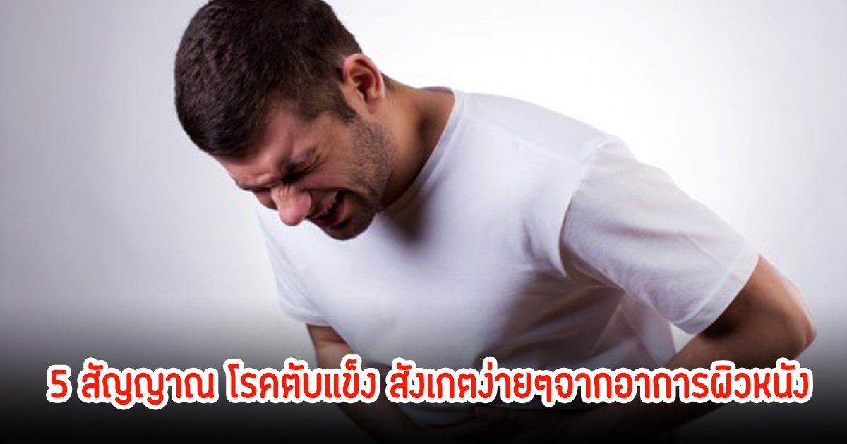 5 สัญญาณเตือน! เป็นโรคตับแข็ง สังเกตง่ายๆจากอาการผิวหนัง บางคนเป็นไม่รู้ตัว เพราะมักมองข้าม