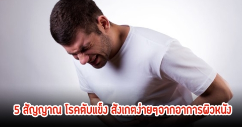 5 สัญญาณเตือน! เป็นโรคตับแข็ง สังเกตง่ายๆจากอาการผิวหนัง บางคนเป็นไม่รู้ตัว เพราะมักมองข้าม