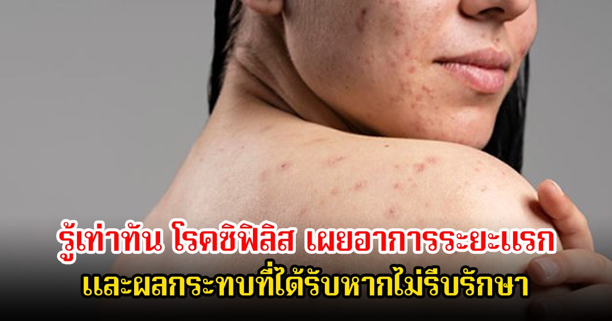 รู้เท่าทัน โรคซิฟิลิส เผยอาการระยะแรก และผลกระทบที่ได้รับหากไม่รีบรักษา