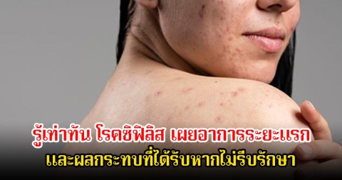 รู้เท่าทัน โรคซิฟิลิส เผยอาการระยะแรก และผลกระทบที่ได้รับหากไม่รีบรักษา