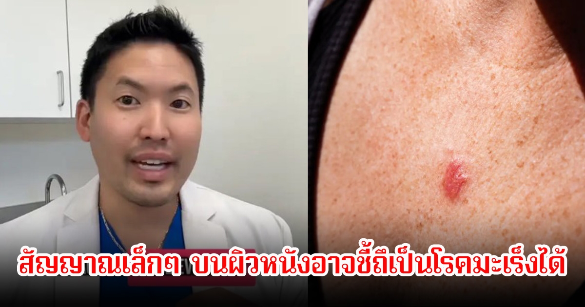 แพทย์เตือน! สัญญาณเล็กๆ บนผิวหนังที่ถูกหลายคนมองข้าม อาจชี้ถึเป็นโรคมะเร็งได้