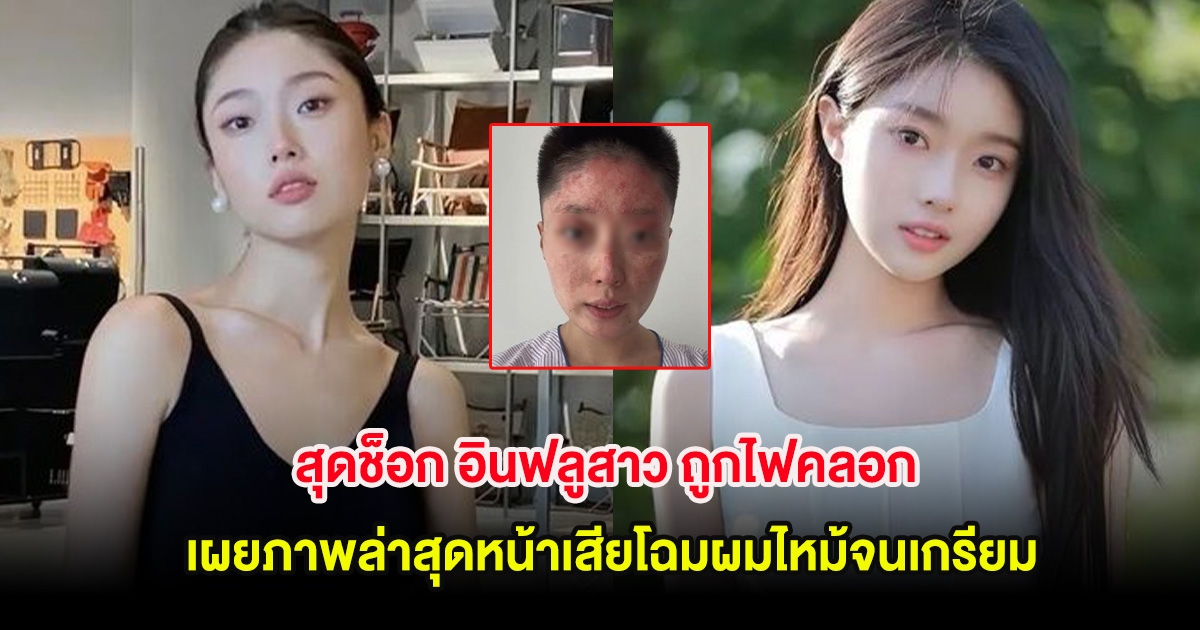 สุดช็อก อินฟลูสาว ถูกไฟคลอก เผยภาพล่าสุดหน้าเสียโฉมผมไหม้จนเกรียม (ต่างประเทศ)