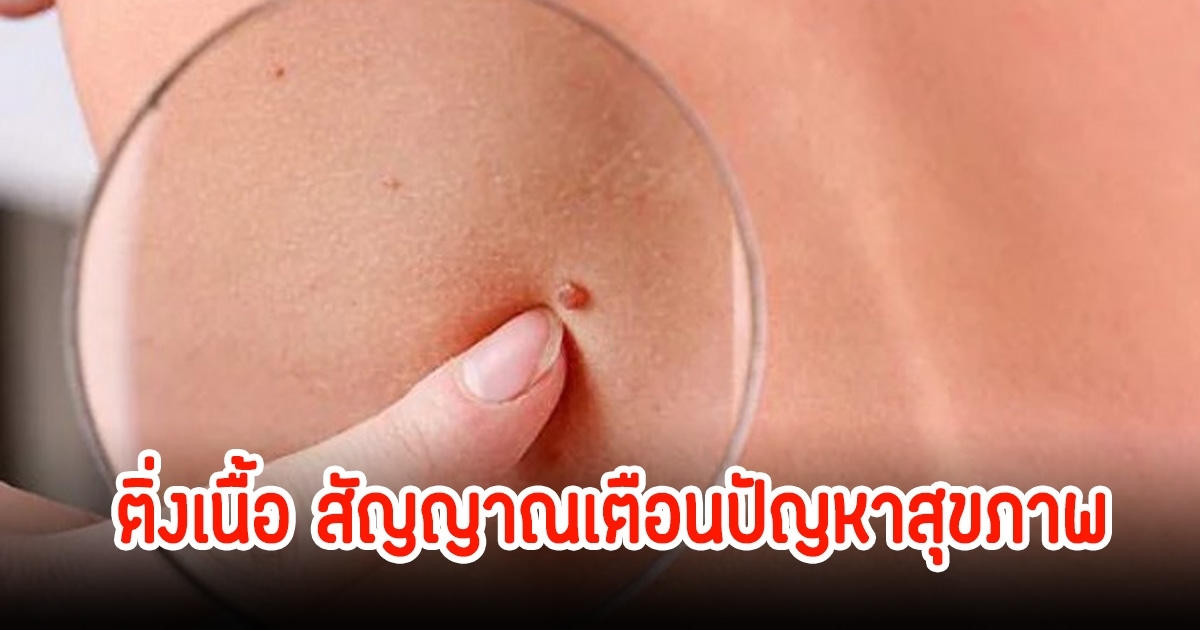 สัญญาณเตือน! เป็นมะเร็ง 2 ชนิด หมอสังเกตเห็นติ่งเนื้อที่คอ
