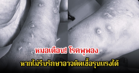 หมอเตือน! โรคพุพอง หน้าฝนเด็กเป็นเยอะมาก อย่าปล่อยไว้นาน หากไม่รีบรักษาอาจติดเชื้อรุนแรงได้