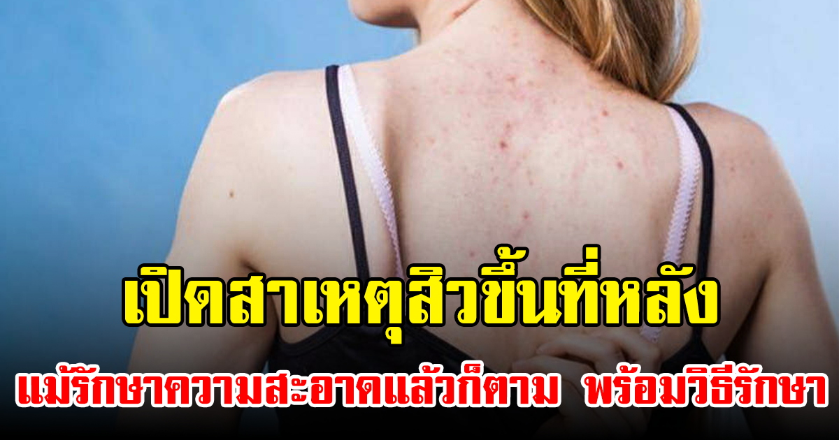 เปิดสาเหตุสิวขึ้นที่หลัง แม้รักษาความสะอาดแล้วก็ตาม พร้อมวิธีรักษา