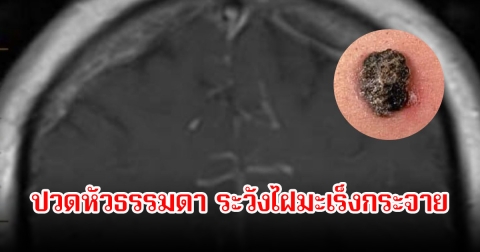 หมอเตือน! ปวดหัวธรรมดา ระวังไฝมะเร็งกระจาย เผยอาการรีบสังเกตเลย