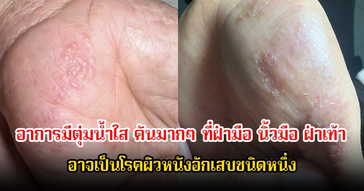 อย่าชะล่าใจ! มีอาการมีตุ่มน้ำใส คันมากๆ ที่ฝ่ามือ นิ้วมือ ฝ่าเท้า อาจเป็นโรคผิวหนังอักเสบชนิดหนึ่ง รีบรักษาก่อนสายเกินไป