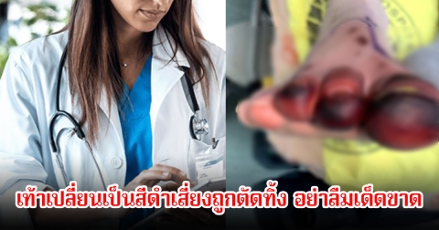 แพทย์ยังไม่รอด เตือนหลายคน เท้าเปลี่ยนเป็นสีดำเสี่ยงถูกตัดทิ้ง อย่าลืมเด็ดขาด