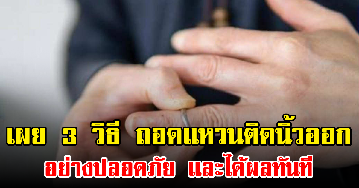 เผย 3 วิธี ถอดแหวนติดนิ้วออกอย่างปลอดภัย และได้ผลทันที