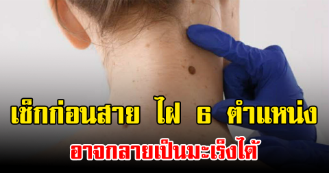 เช็กก่อนสาย ไฝ 6 ตำแหน่ง อาจกลายเป็นมะเร็งได้