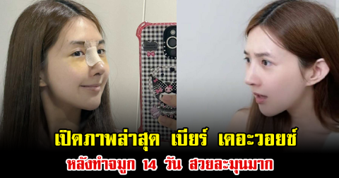 เปิดภาพล่าสุด เบียร์ เดอะวอยซ์ หลังทำจมูก 14 วัน สวยละมุนมาก