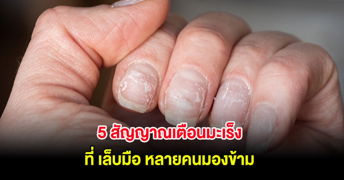 5 สัญญาณเตือนมะเร็ง ที่ เล็บมือ หลายคนมองข้าม