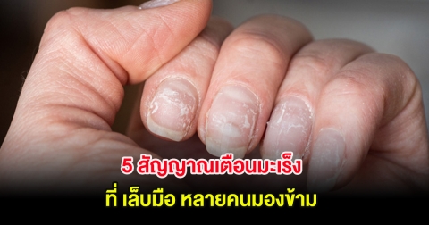 5 สัญญาณเตือนมะเร็ง ที่ เล็บมือ หลายคนมองข้าม