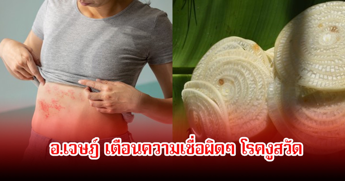 อ.เจษฎ์ เตือนความเชื่อผิดๆ โรคงูสวัด อย่าหลงเชื่อเด็ดขาด